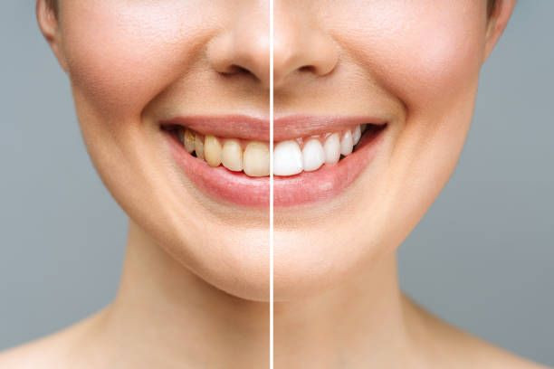 Diş taşı (Tartar) nedir? Diş taşı nasıl önlenir?