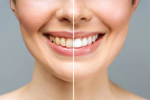 Diş taşı (Tartar) nedir? Diş taşı nasıl önlenir?