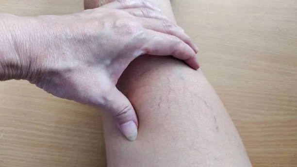 Bacaklarda görülen bu belirtilere dikkat! Varis nedir? Nedenleri ve belirtileri nelerdir?