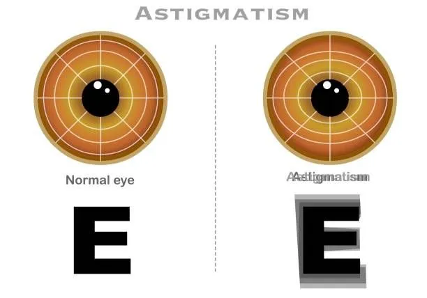 Dünyayı net görün: Astigmatın tanısı ve tedavi yöntemleri! Kesin çözüm nedir?